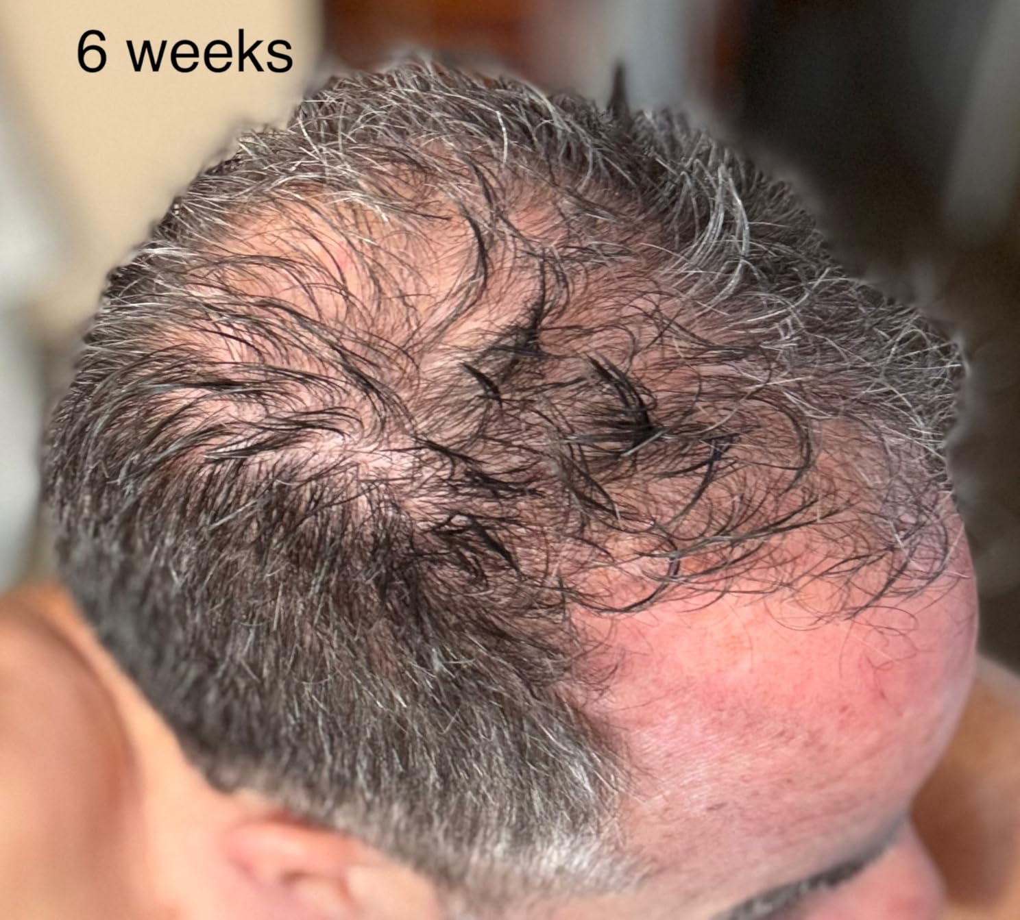 iRestore Professional Laser Red Light Therapy for Hair Growth System - FDA Cleared Hair Loss & Hair Thinning Treatment - 282 Lasers & LEDs customer photo 1