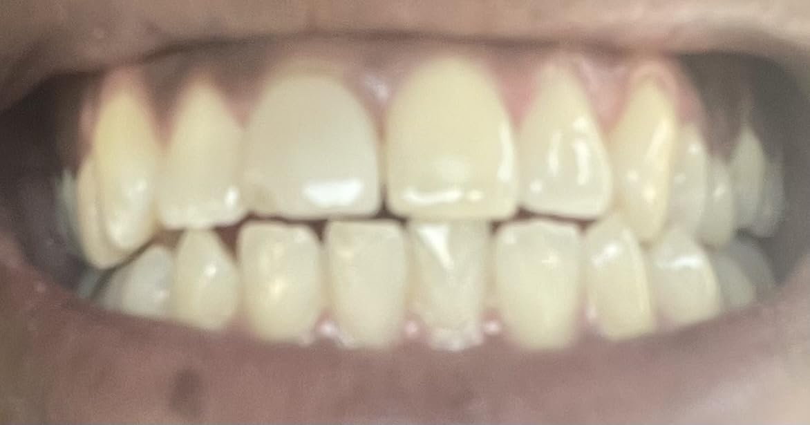 Opalescence Go 15% Mint - Prefilled Teeth Whitening Trays - 5194 customer photo 1