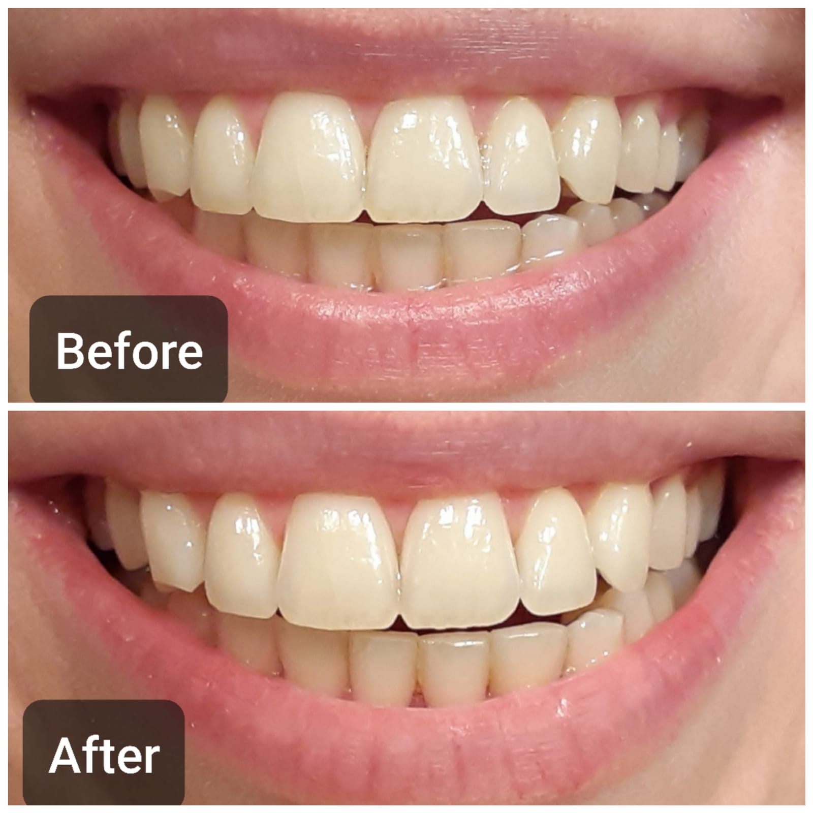 Auraglow Teeth Whitening Kit, LED Accelerator Light, 35% Carbamide Peroxide Teeth Whitening Gel, 20+ Whitening Treatments, Whitens up to 10 Shades in 7 Days customer photo 1