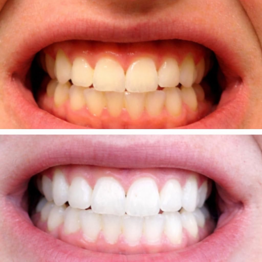 Teeth Whitening Trays for Gel 4 Pc Moldable Flexible Guards with 2 Cases customer photo 2