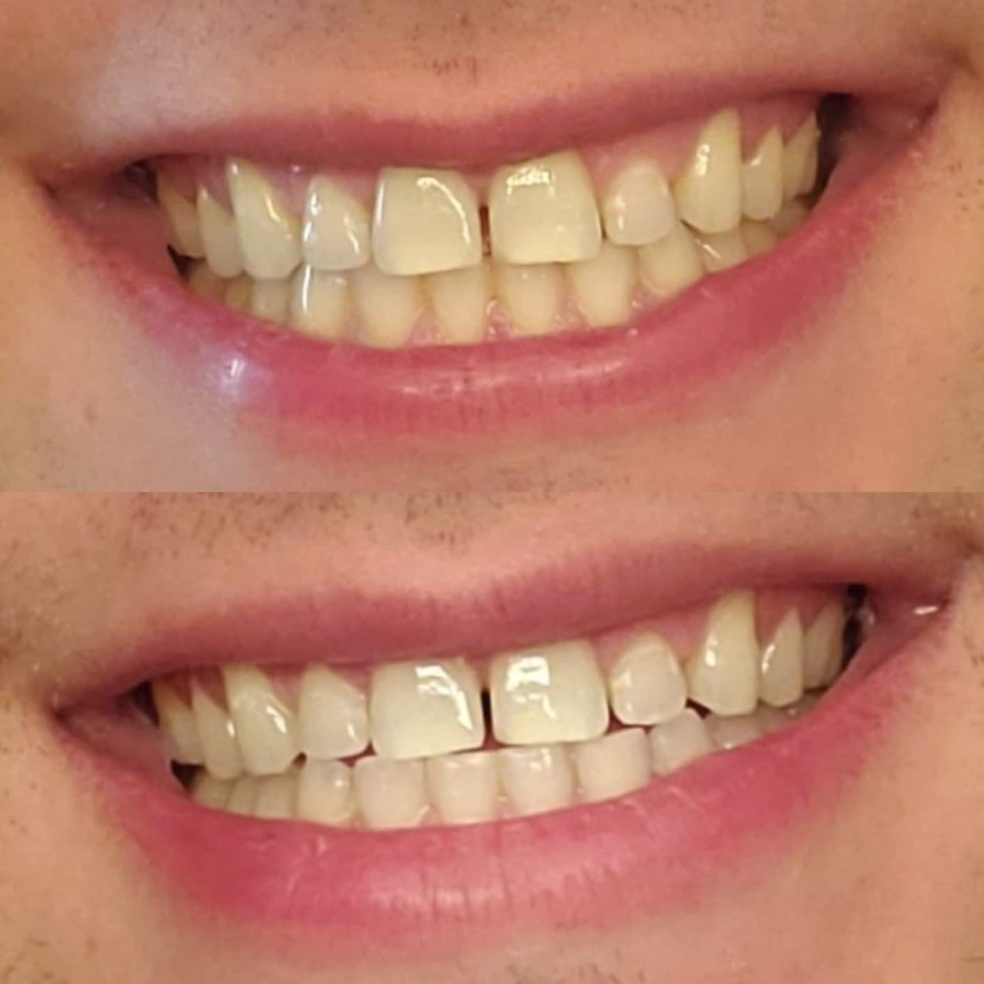 Crest 3D Whitestrips Express Whitening with Light, Whitestrips 3D White, Teeth Whitening Strip Kit, 20 Strips (10 Count Pack), Crest Teeth Whitening Strips, Teeth Whitening Kit customer photo 2