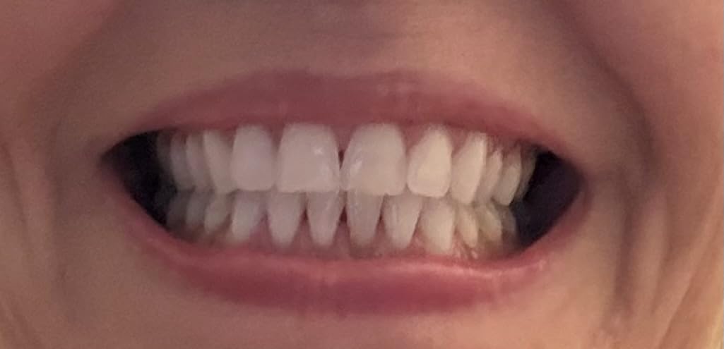 Novashine Professional Teeth Whitening Kit: Advanced Blue LED Light, Concentrated Peroxide Gel, Smartphone Adapter, Travel Bag customer photo 2