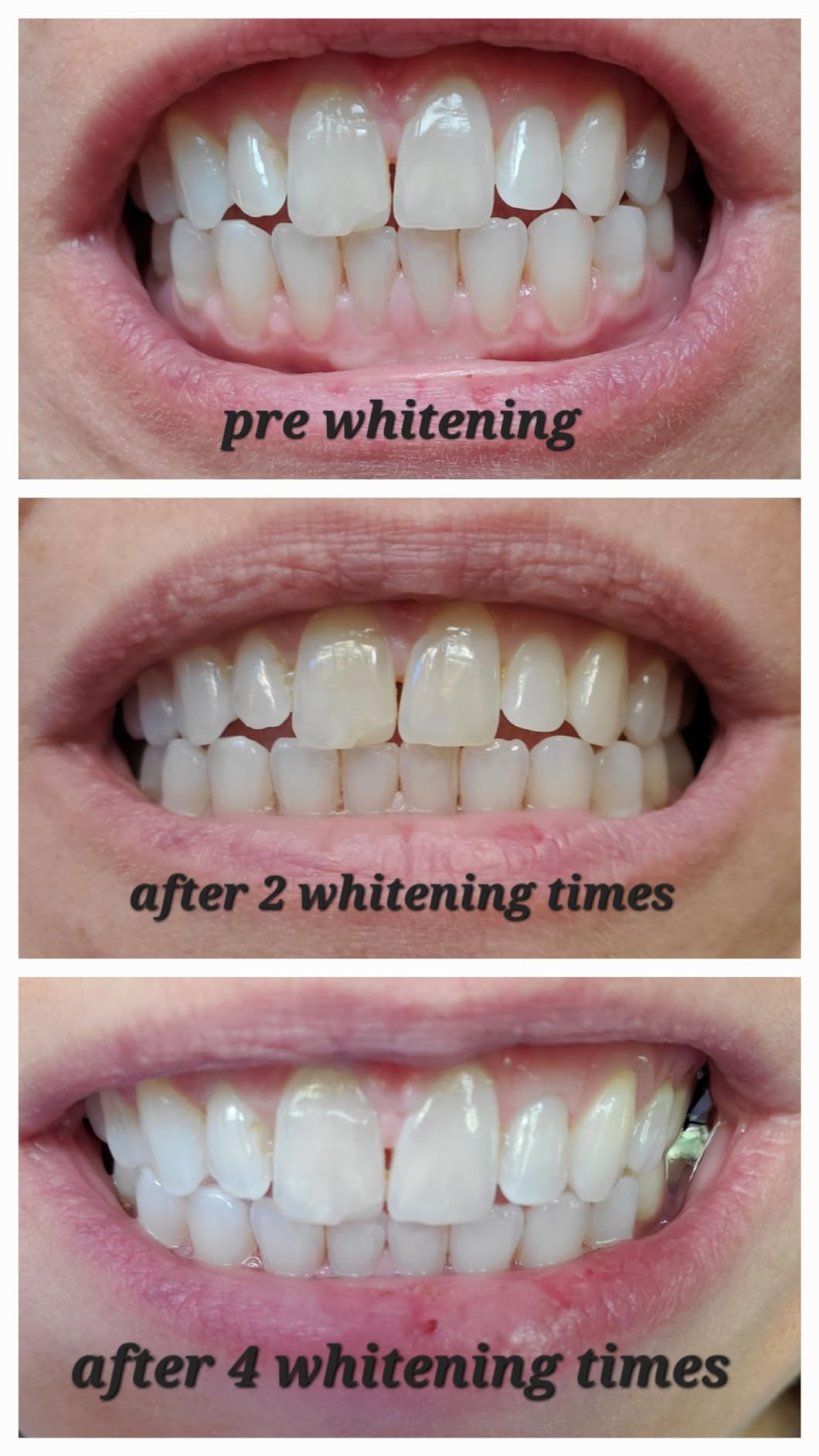 SmileDirectClub Teeth Whitening Kit with LED Light - 4 Pack Gel Pens - Professional Strength Hydrogen Peroxide customer photo 1