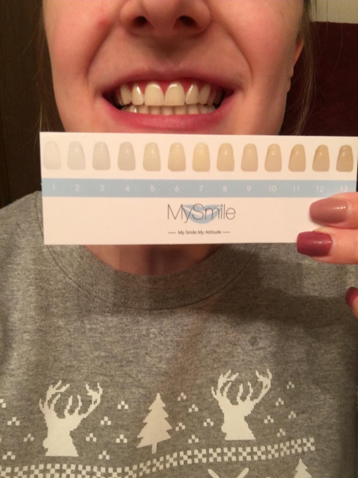 MySmile Teeth Whitening LED Light w/Mouth Tray Home Oral Whitening Device customer photo 1