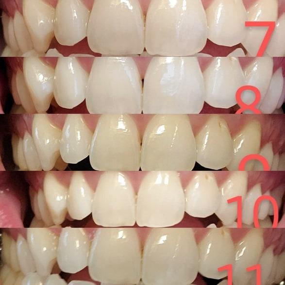 MySmile Teeth Whitening LED Light w/Mouth Tray Home Oral Whitening Device customer photo 2