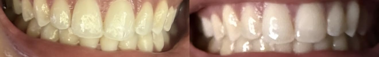 Lumineux Teeth Whitening Strips, Peroxide Free, 9 Treatments (1 Month) customer photo 1