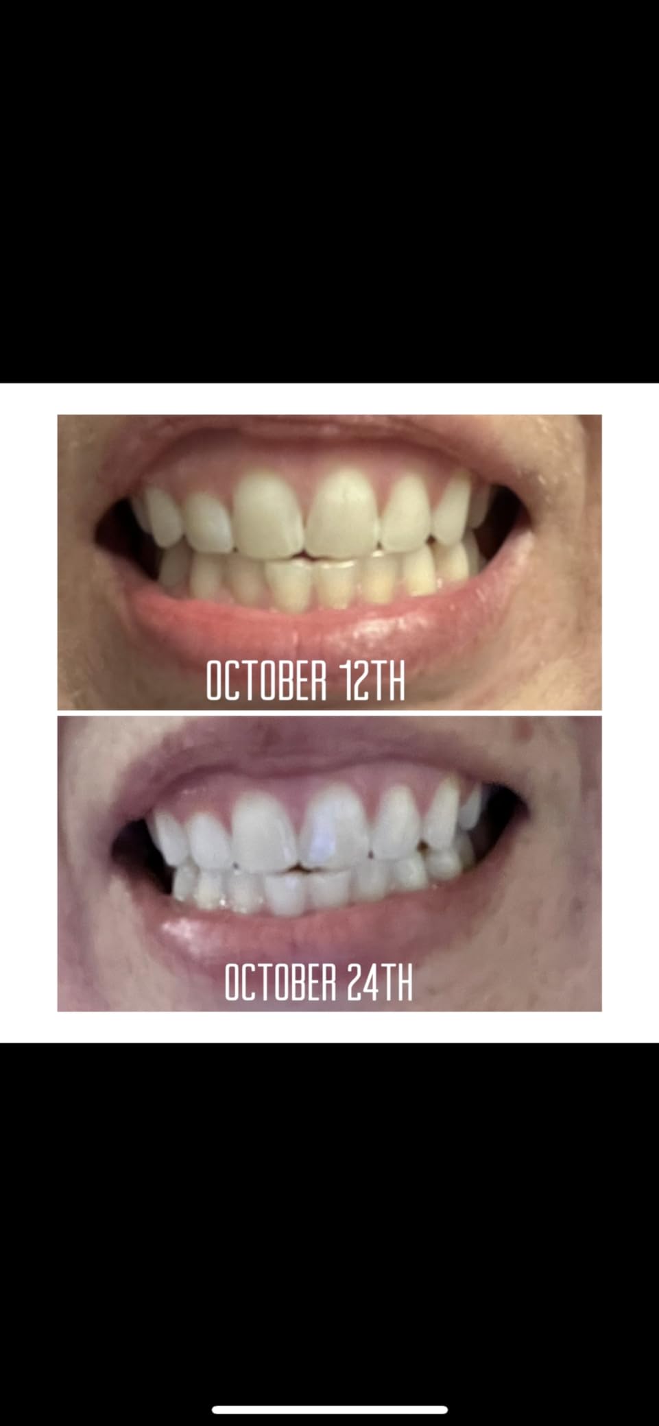 MOON Teeth Whitening Kit, LED Light Teeth Whitener Device, 56 White Strips, USB Charger & Travel Case, Blue Light Whitening Tray Removes Stains & Whitens Up to 12 Shades in 2 Weeks (4 Piece Kit) customer photo 2