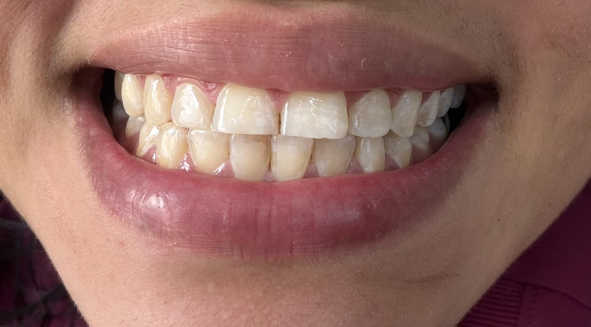GuruNanda Teeth Whitening Strips - 4X Whiter Teeth, 7-Day Whitening Kit customer photo 2
