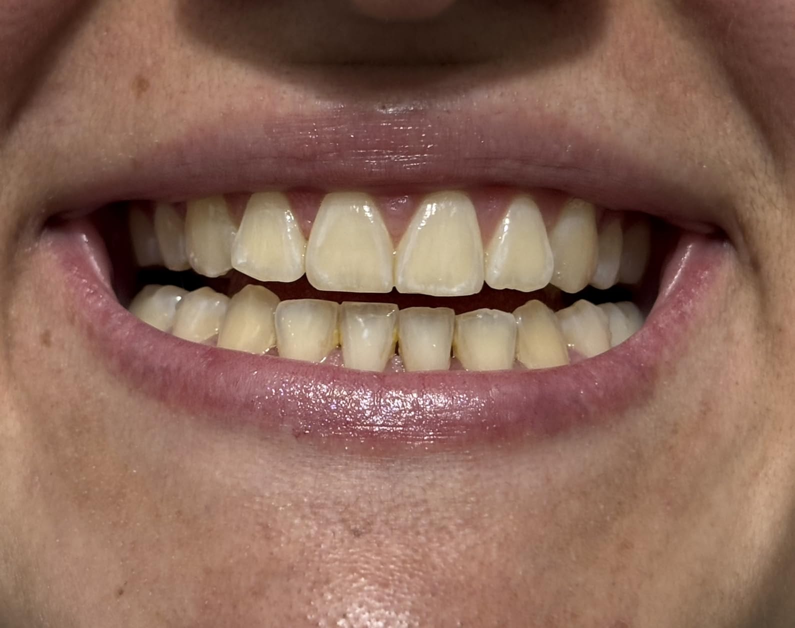 Crest 3DWhitestrips Sensitive White At-Home Teeth Whitening Kit, 18 Treatments, Gently Removes 15 Years of Stains customer photo 1