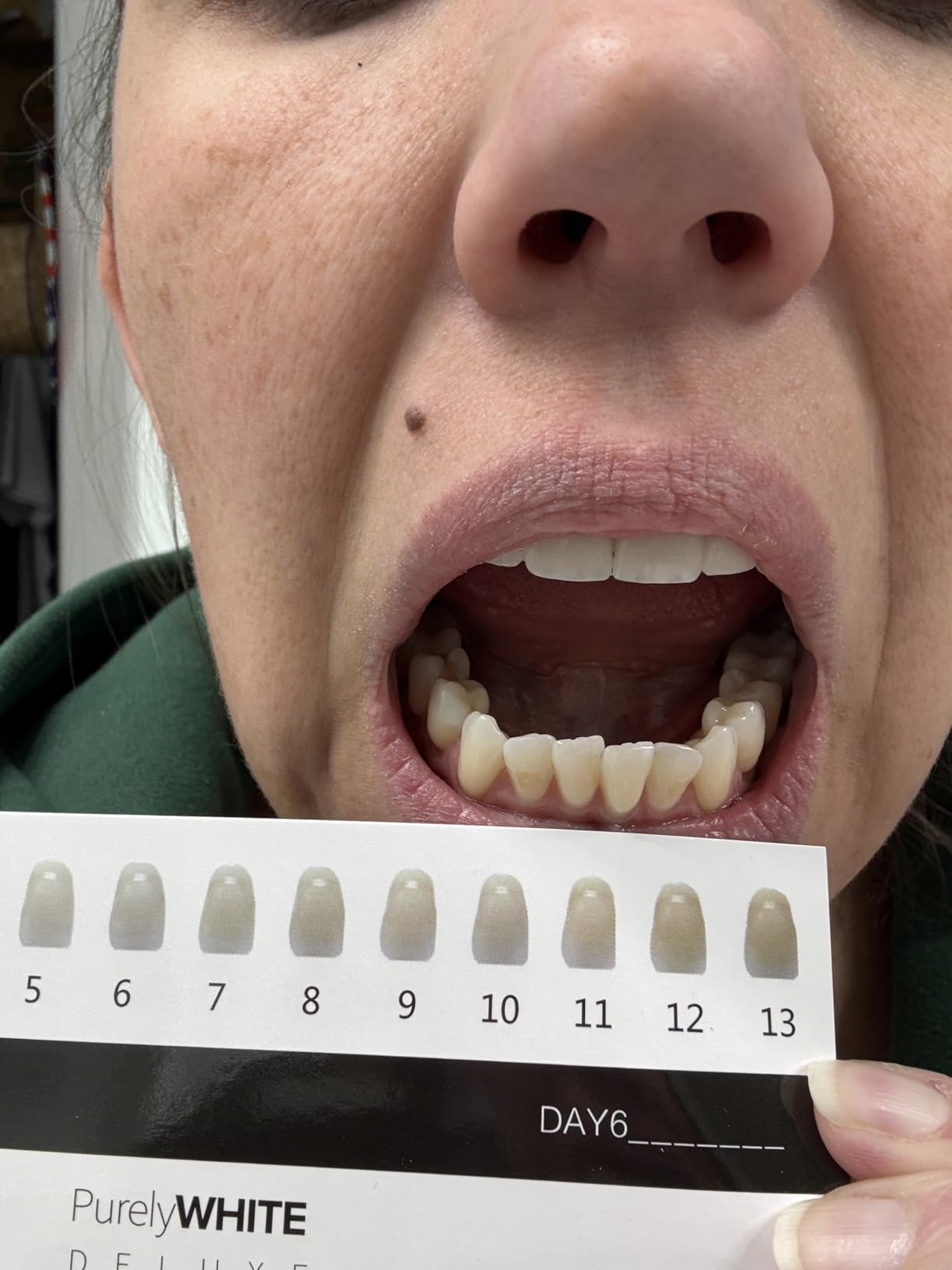 PurelyWHITE DELUXE Teeth Whitening Kit, Complete LED Teeth Whitening, 15+ Treatments, (3) 3ml Whitening Gel Syringes, Whiter Smile in 7 Minutes customer photo 1
