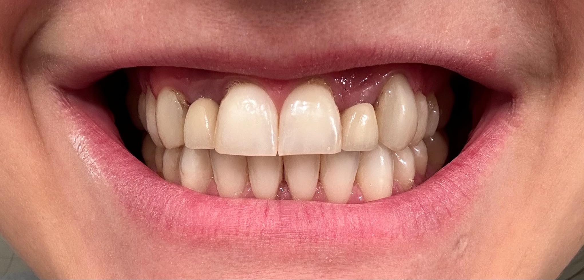 PurelyWHITE DELUXE Teeth Whitening Kit, Complete LED Teeth Whitening, 15+ Treatments, (3) 3ml Whitening Gel Syringes, Whiter Smile in 7 Minutes customer photo 2