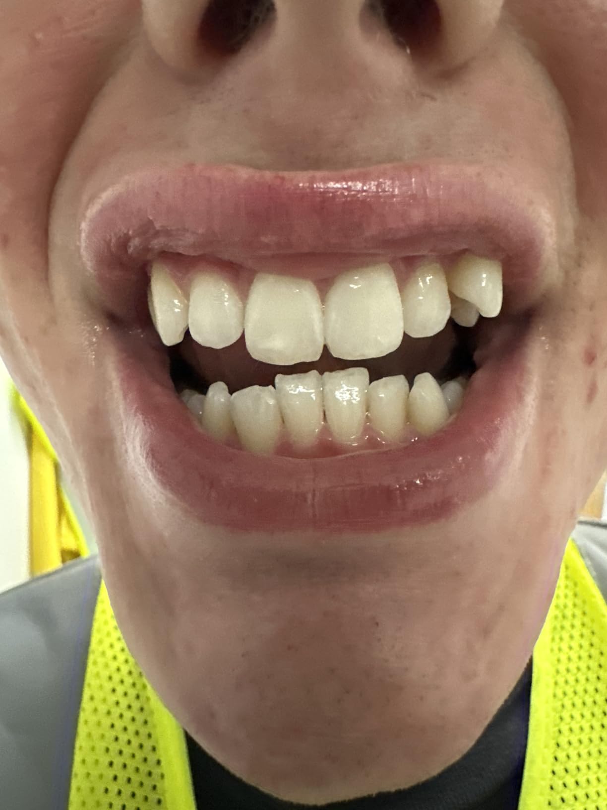 GuruNanda Teeth Whitening Strips - 4X Whiter Teeth, 16-Day Whitening Kit customer photo 1