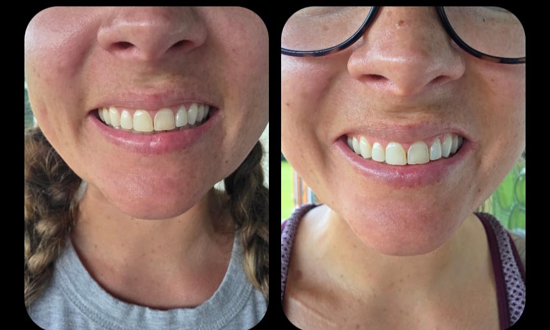 GuruNanda Teeth Whitening Strips - 4X Whiter Teeth, 16-Day Whitening Kit customer photo 2