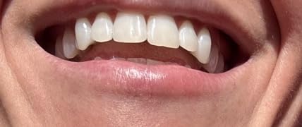 Opalescence GO 15 Teeth Whitening Trays Bundle - Hydrogen Peroxide 6288-T customer photo 1