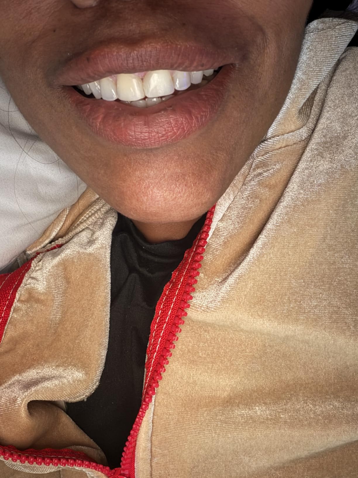 GuruNanda Teeth Whitening Kit, Up to 10 Shades Whitening, 40 Treatments customer photo 1