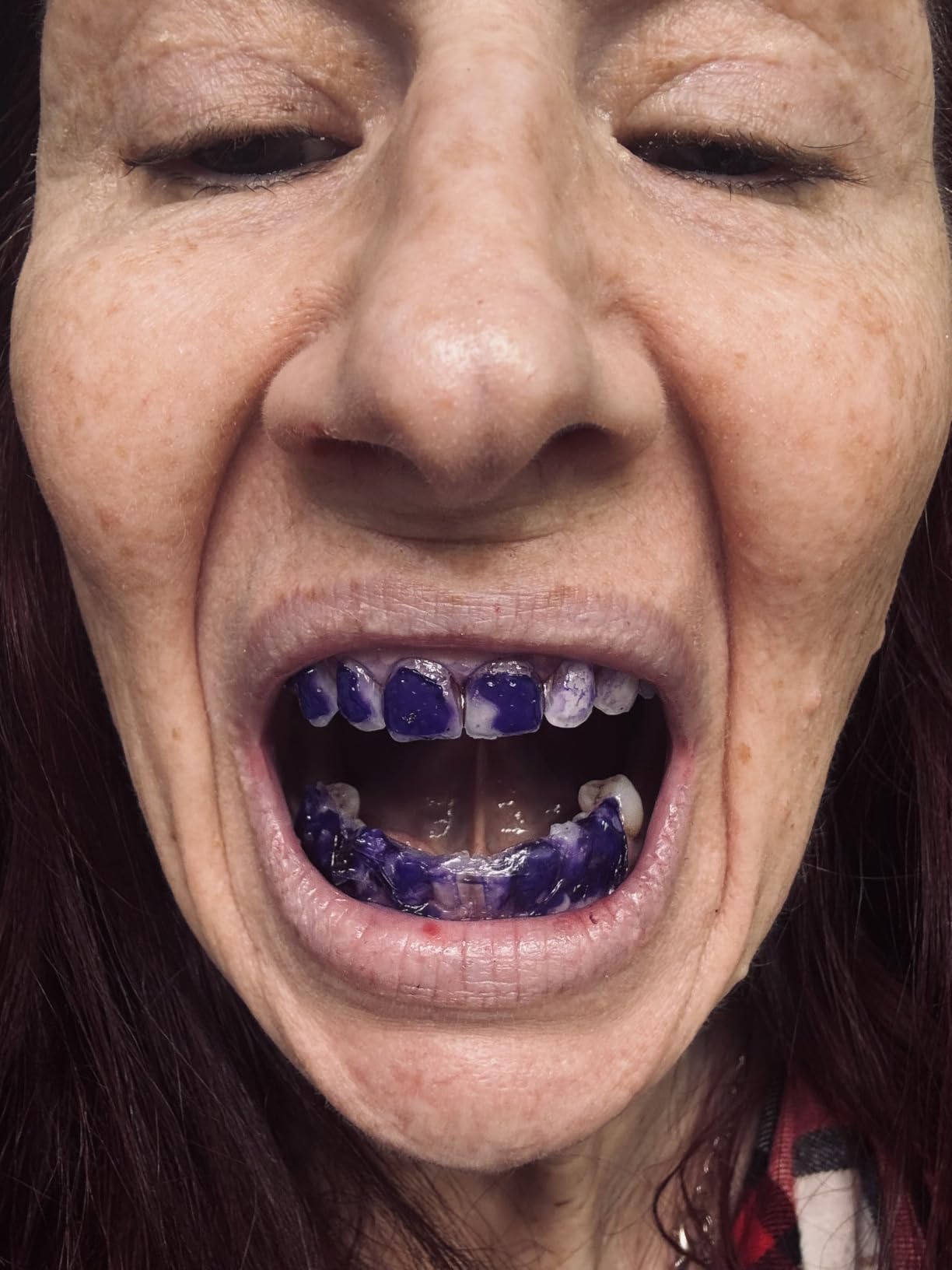 Purple Teeth Whitening Strips for Sensitive Teeth 28 Count Whitener Strips customer photo 1